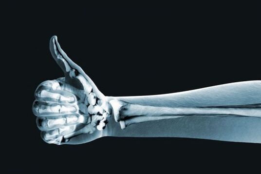 X-ray to diagnose finger joint pain
