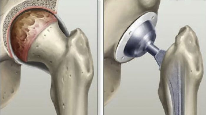 Hip arthroplasty performed in the final stages of coxarthrosis
