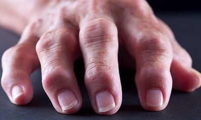 What is the difference between arthritis of arthrosis