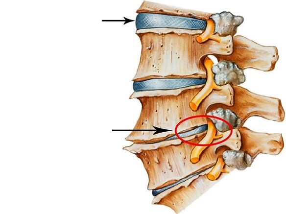 Disorders on intervertebral discs