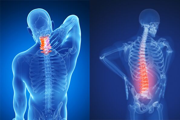 Osteochondrosis of the cervical and lumbar spine