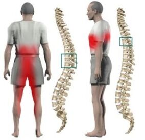 Lumps on the spine
