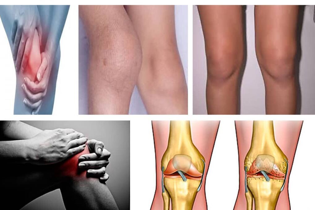 arthrosis what is it