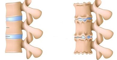 How to recognize the presence of lumbar osteochondrosis