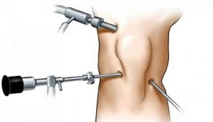 arthroscopy for knee joint arthrosis