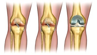 endoprosthesis for arthrosis of the knee joint